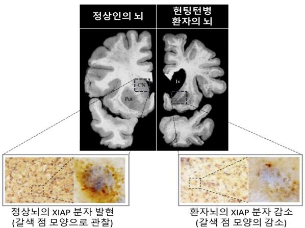 정상뇌의 XIAP 분자 발현(왼쪽)과 환자뇌 XIAP 분자 감소(오른쪽). XIAP 분자를 면역조직화학법으로 염색해 갈색으로 관찰 할 수 있게 처리. (ⓒ KIST)